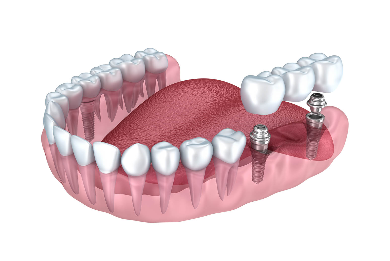 Implant dentaire : Quelles sont les contraintes liées à l’implant ?